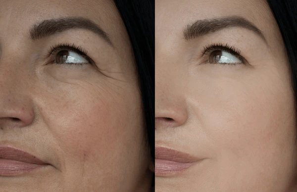woman-face-wrinkle-before-after-600nw-2295769017