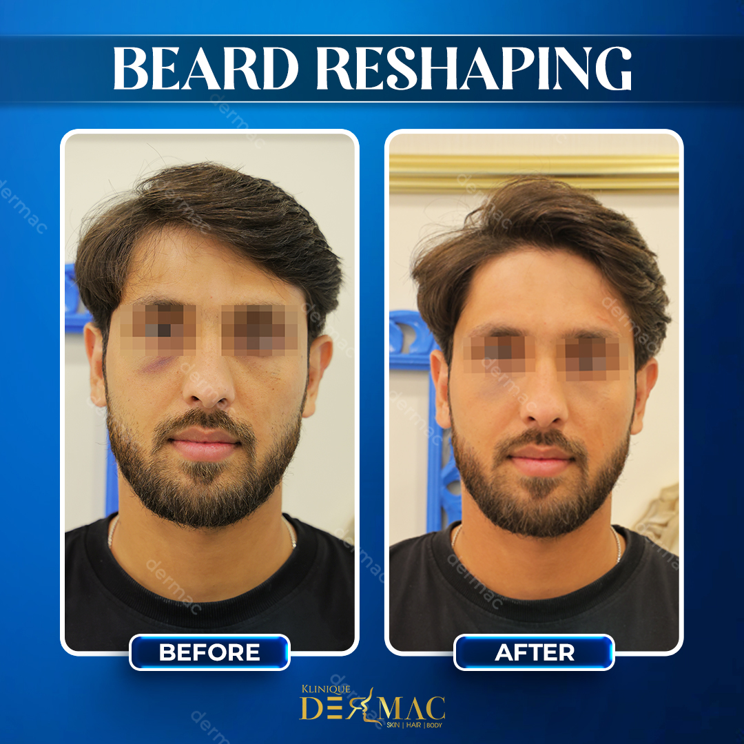 Beard Reshaping Post