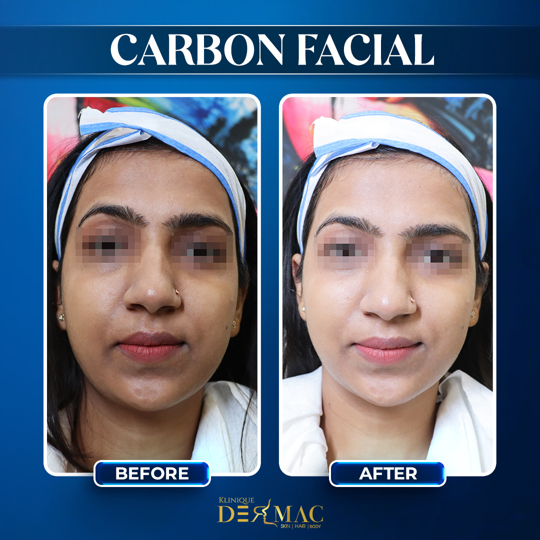 Dermac Carbon Facial Before After post (1)