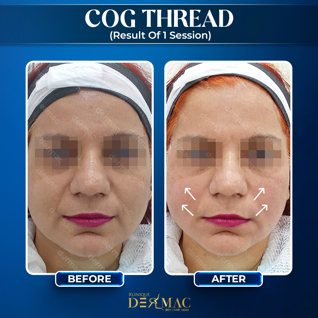 Dermac updated before after post