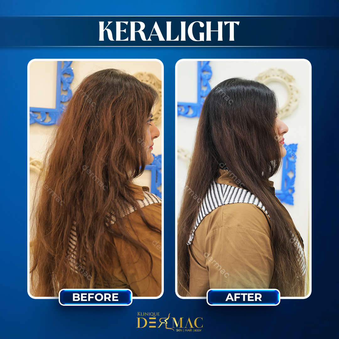 keralight before and after1