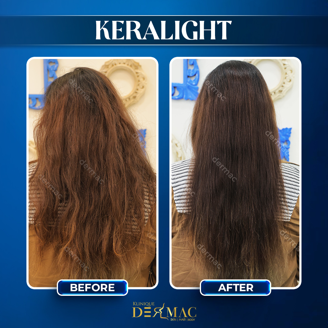 keralight before and after2